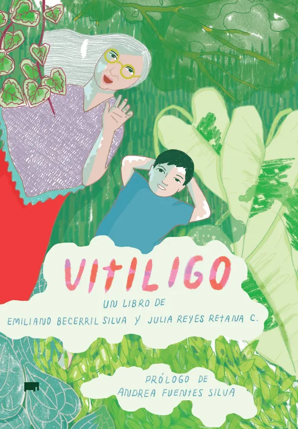 Vitiligo